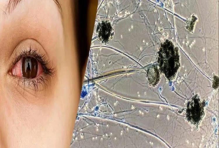 कोरोना ही नहीं ब्लैक फंगस ने भी बढ़ाई सरकार की चिंता, 421 मामले आए सामने