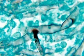 अब ये कैसी मुसीबत, कभी नहीं हुआ कोरोना, फिर भी ब्लैक फंगस की चपेट में आ गए 32 लोग