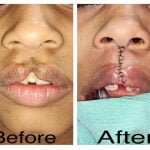 जन्म से कटे होंठ और तालू वाले बच्चों की नि:शुल्क सर्जरी