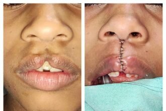 जन्म से कटे होंठ और तालू वाले बच्चों की नि:शुल्क सर्जरी