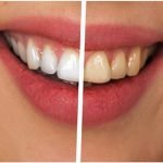 दांतो में पीलापन, शरीर की हड्डियों में विकृति या टेढ़ापन फ्लोरोसिस के लक्षण