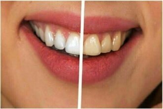 दांतो में पीलापन, शरीर की हड्डियों में विकृति या टेढ़ापन फ्लोरोसिस के लक्षण