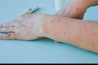 मंकीपॉक्स से देश में पहली मौत: केरल के युवक की दूसरी जांच रिपोर्ट में भी मिला वायरस, 20 लोग क्वारंटाइन