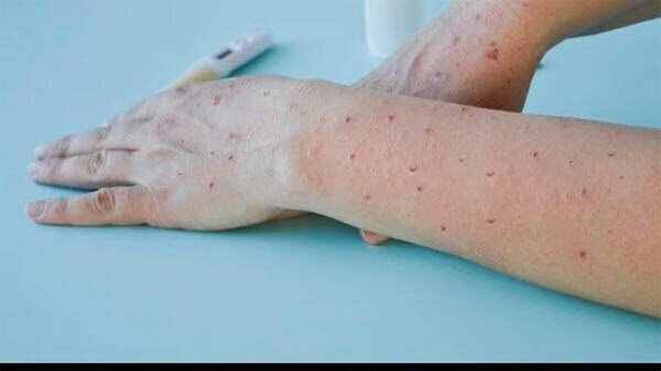 मंकीपॉक्स से देश में पहली मौत: केरल के युवक की दूसरी जांच रिपोर्ट में भी मिला वायरस, 20 लोग क्वारंटाइन