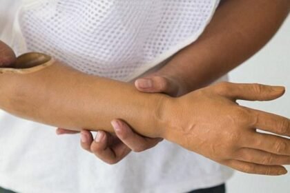 अमेरिका कृत्रिम हाथ लगाने इस जिले में लगेगा नि:शुल्क शिविर, 10 विशेषज्ञ डॉक्टर रहेंगे मौजूद, ऐसे कराएं पंजीयन