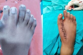 Durg Big News: जिला अस्पताल में दो जटिल आपरेशन रहा सफल, एक के पैर में थी 7 उंगलिया, और दूसरे का दिल बाईं ओर की जगह दाईं ओर