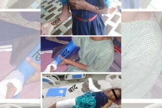 ऑपरेशन के बाद सीमा अब अपना हाथ सीधा कर पाएगी, 'चिरायु' से डीकेएस अस्पताल में हुई नि:शुल्क सर्जरी