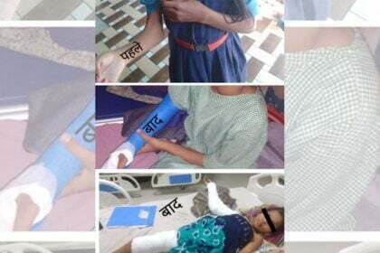 ऑपरेशन के बाद सीमा अब अपना हाथ सीधा कर पाएगी, 'चिरायु' से डीकेएस अस्पताल में हुई नि:शुल्क सर्जरी