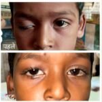 चिरायु योजना से आठ वर्षीय द्रुप के पलकों के पक्षाघात का हुआ सफल उपचार