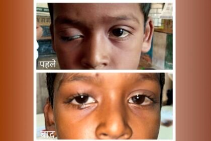 चिरायु योजना से आठ वर्षीय द्रुप के पलकों के पक्षाघात का हुआ सफल उपचार