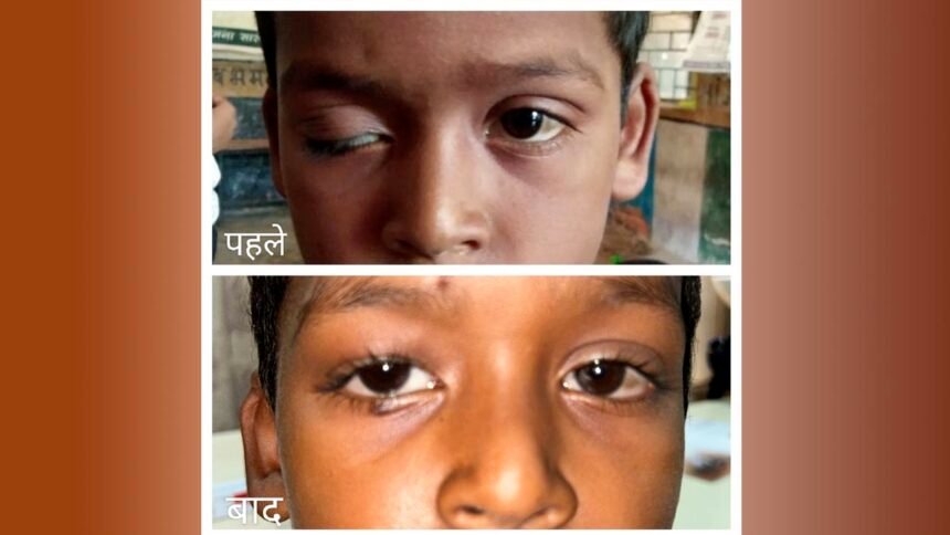 चिरायु योजना से आठ वर्षीय द्रुप के पलकों के पक्षाघात का हुआ सफल उपचार