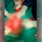 सीसीएम में एक और बड़ी उपलब्धि, 3 किलो बड़े ट्यूमर की सफल सर्जरी