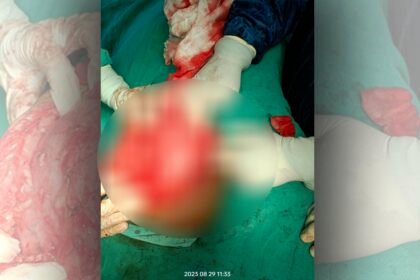 सीसीएम में एक और बड़ी उपलब्धि, 3 किलो बड़े ट्यूमर की सफल सर्जरी