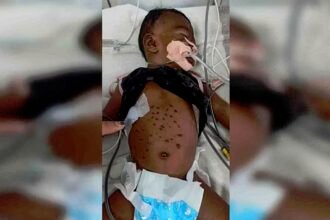 अंधविश्वास के चक्कर में जिंदगी और मौत की जंग लड़ रही 3 माह की मासूम, 51 बार गर्म सलाखों से दागा